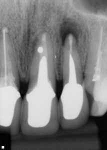左上顎2番 歯根端切除術　術直後X-p