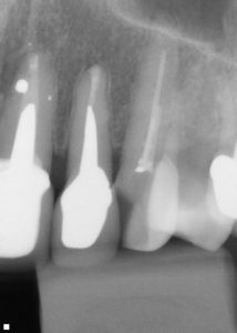 左上顎2番歯根端切除術　術後5年半X-p